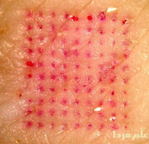 اثر سوزن های ریز روی پوست ، بعد از تزریق واکسن توسط برچسب واکسن