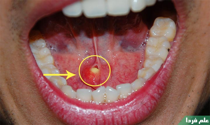 بیماری سنگ غده بزاق یا salivary gland stone